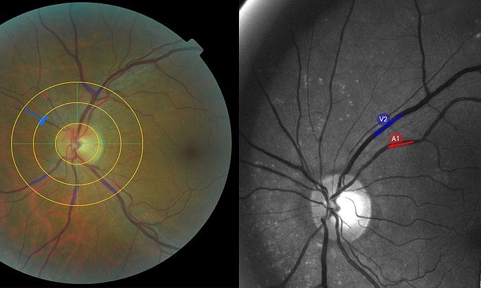 Two images from eye examinations